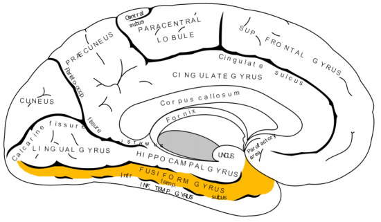 Fig. 1. Neural misfiring in the fusiform gyrus might be a cause of Cotard’s Syndrome (Pearn 2002)